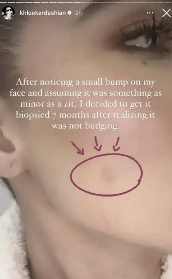 Close-up of a Khloé Kardashian&#x27;s cheek with text about noticing a small bump, thinking it was a zit, deciding on a biopsy after 7 months